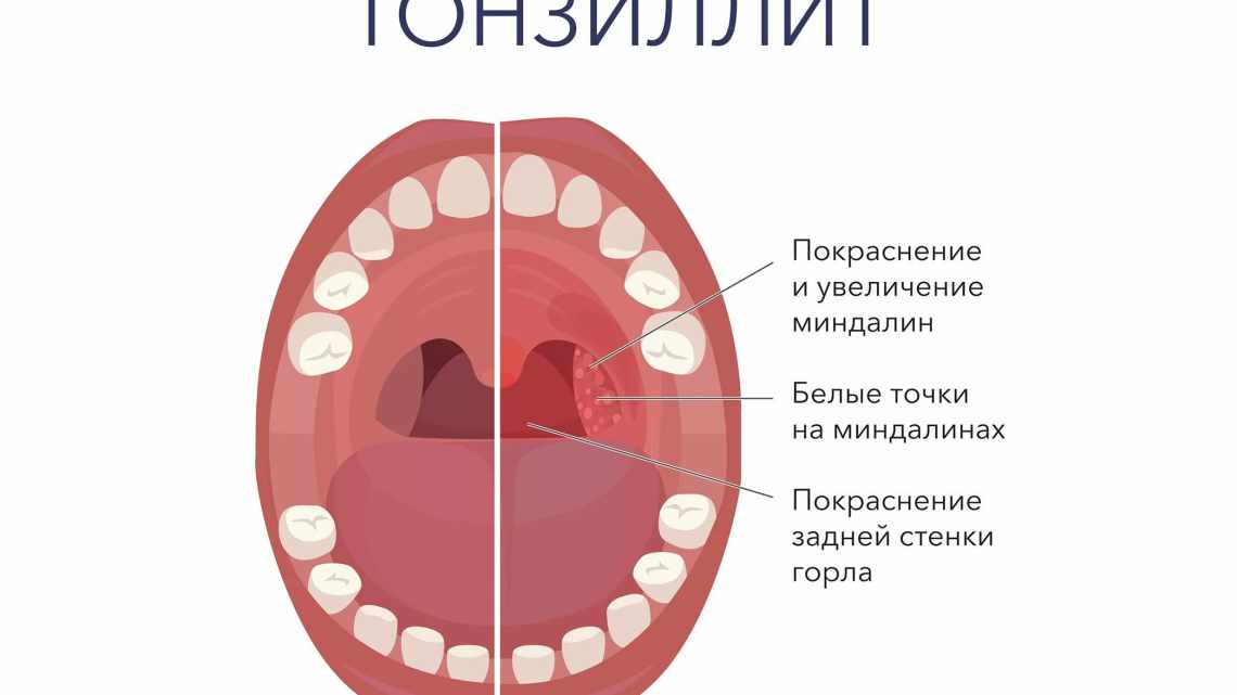 Ангина: причины, симптомы, лечениеАнгина — острое инфекционное заболевание. И самое страшное в ангине  – это последствия от неправильного лечения. Ангина способна вызвать поражения легочной системы, суставов, почек, пищеварительной системы, лимфатической 