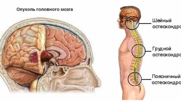 Отек головного мозга: что это такое, причины, симптомы, лечение