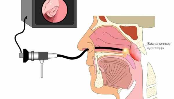 Аденоиды у детей: лечение консервативное и хирургическое, причины, признаки
