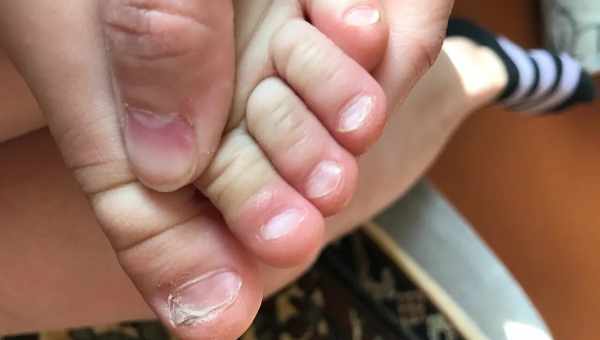 Железодефицитная анемия у детей Ломкие ногти у ребенка – один из признаков железодефицитной анемии